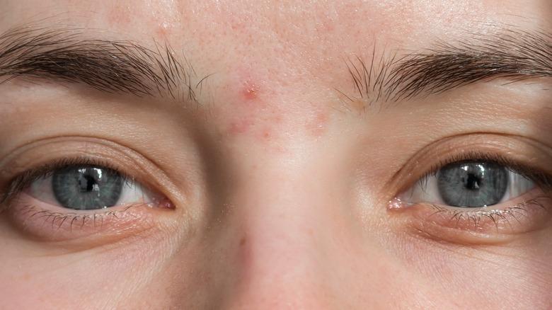 Acne Face Map: What Your Breakouts Say About Your Health